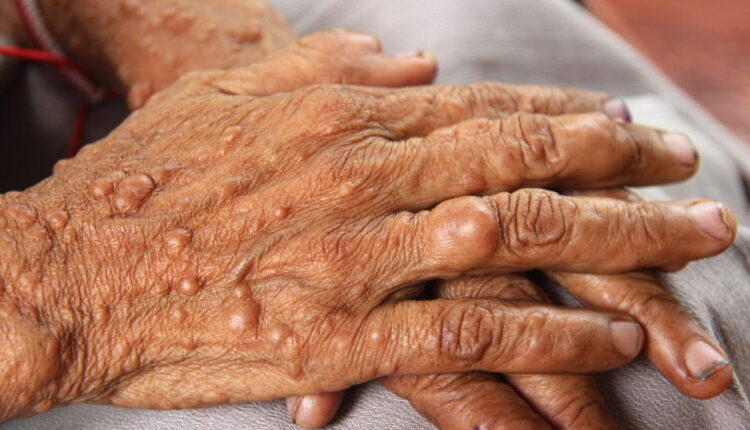 World Neurofibromatosis Awareness Day - May 17