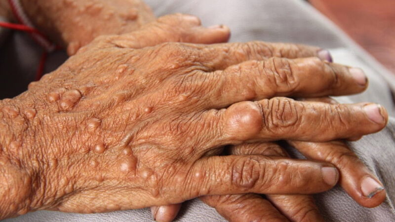 World Neurofibromatosis Awareness Day - May 17