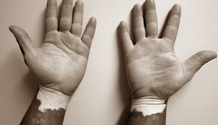 World Vitiligo Day - June 25