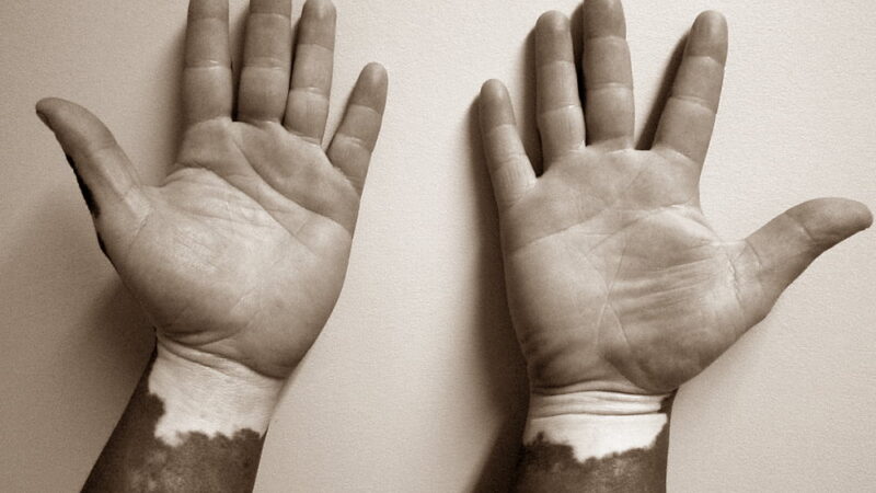 World Vitiligo Day - June 25