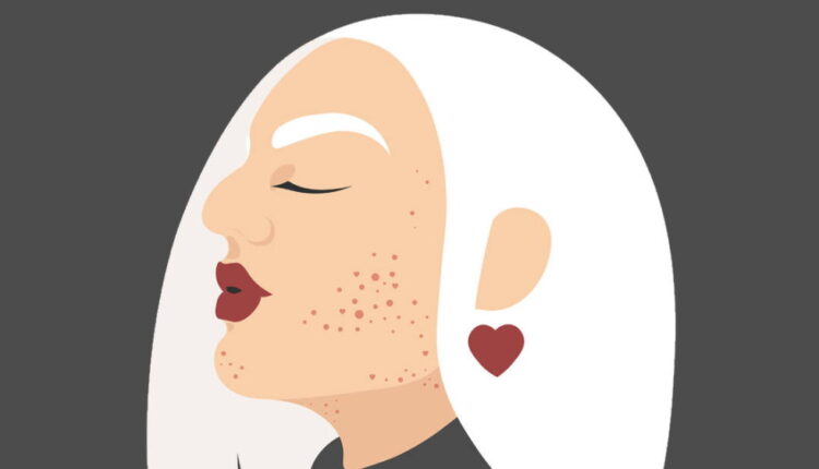 National Acne Positivity Day - September 1