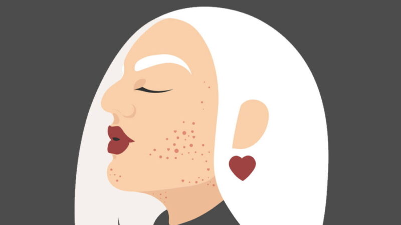 National Acne Positivity Day - September 1
