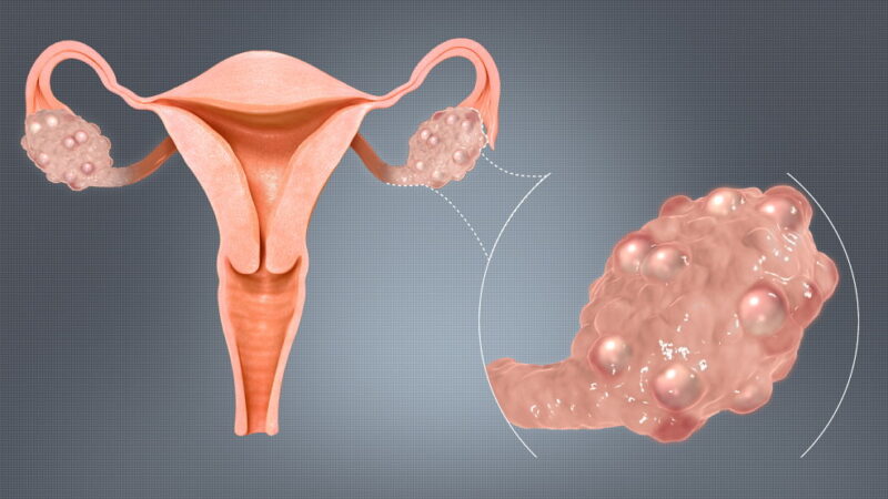 Polycystic Ovarian Syndrome Awareness Month - September