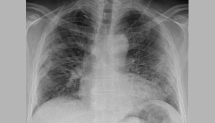 Pulmonary Fibrosis Awareness Month - September