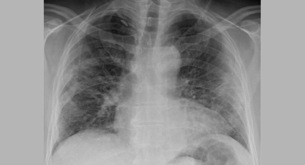 Pulmonary Fibrosis Awareness Month - September