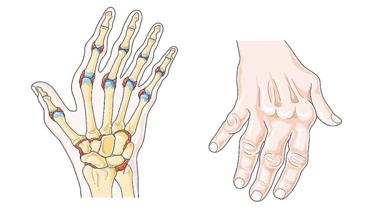World Arthritis Day - October 12