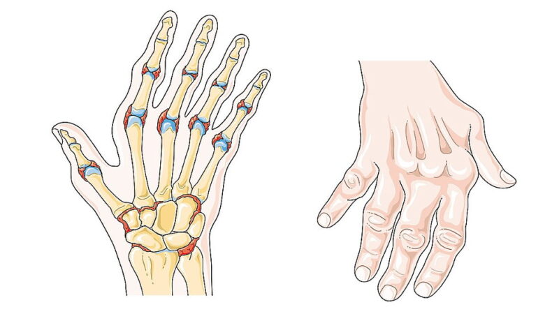 World Arthritis Day - October 12