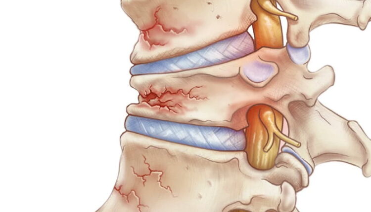 World Osteoporosis Day - October 20