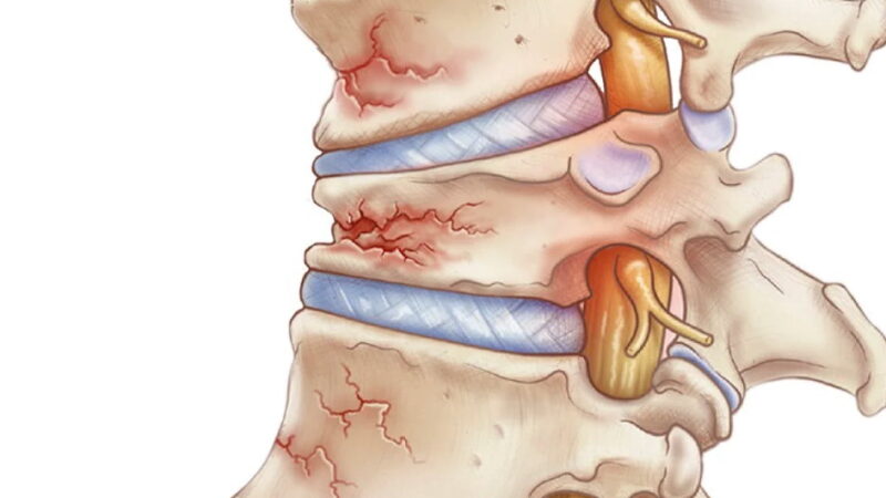 World Osteoporosis Day - October 20
