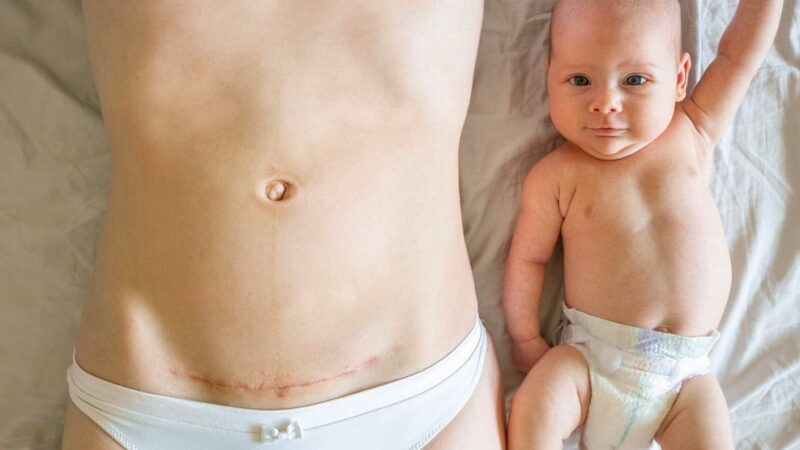 Cesarean Section Day - January 14
