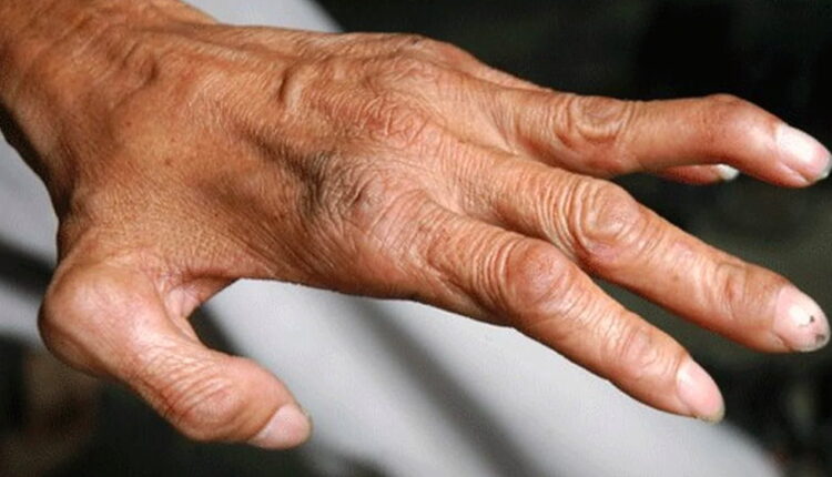 World Leprosy Day - January