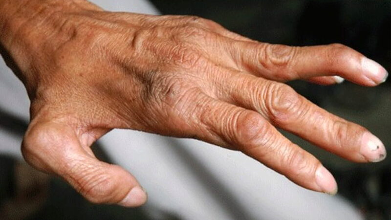 World Leprosy Day - January